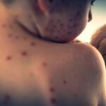 Namibia declares measles outbreak in northwestern region