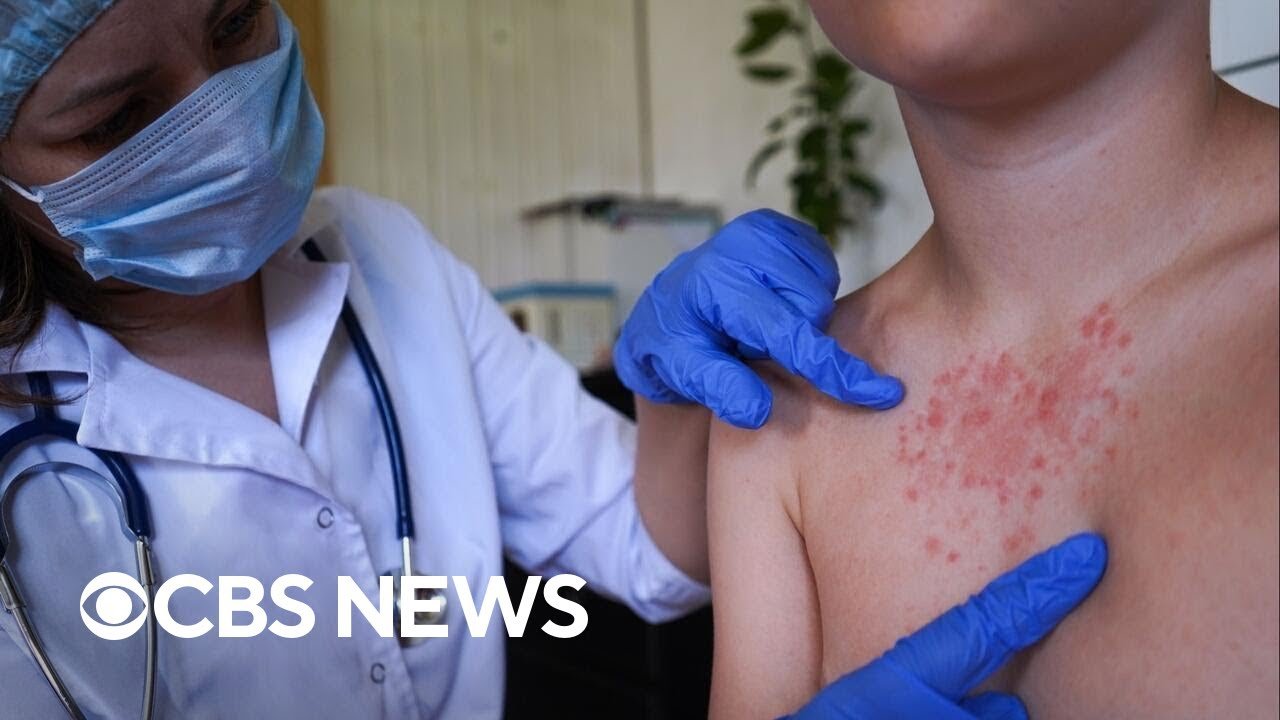 U.S. records highest number of measles cases since 1992, CDC says (Video)