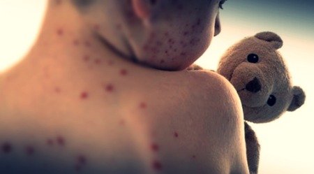 Australia: Measles alert issued for northern Sydney