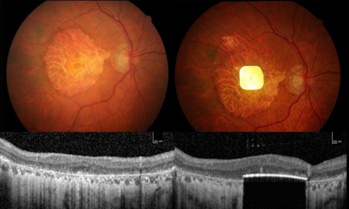 New retinal implant restores vision in patients with irreversible blindness 3 New retinal implant restores vision in patients with irreversible blindness