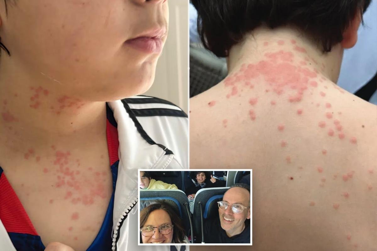Virginia family covered in ‘itchy welts, lesions and rashes’ from bed bug-infested KLM flight: lawsuit