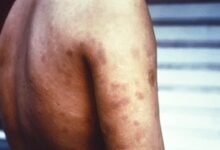 Gujarat brings leprosy prevalence below elimination threshold in 25 districts